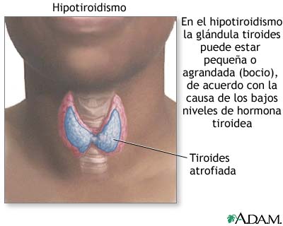 Hipotiroidismo