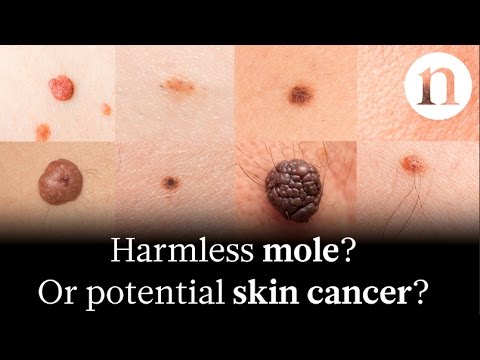 Digital doctor: AI singles out skin cancer from photos