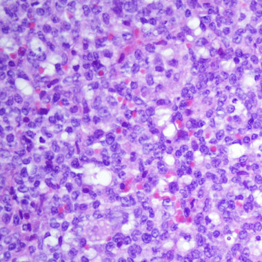Descifran cómo funciona el genoma de la leucemia