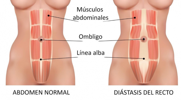Diástasis abdominal: separación de los músculos abdominales