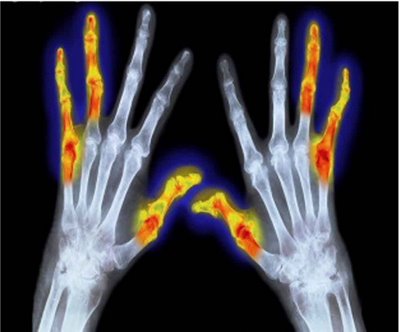 Farmacoterapia personalizada en artritis reumatoide