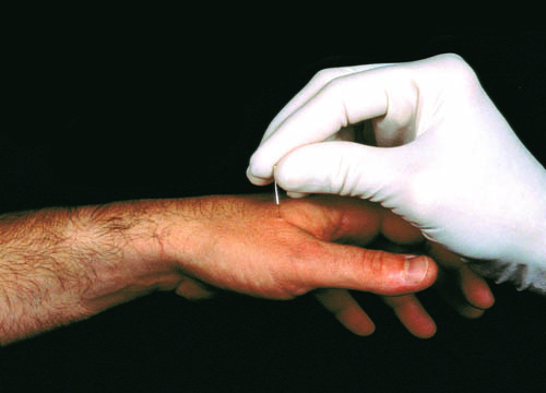 Tratamiento de la infertilidad femenina y masculina con acupuntura