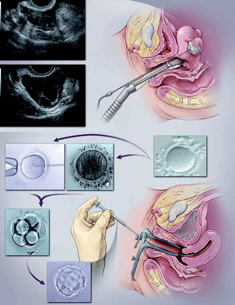 Fertilización In-Vitro: indicaciones actuales