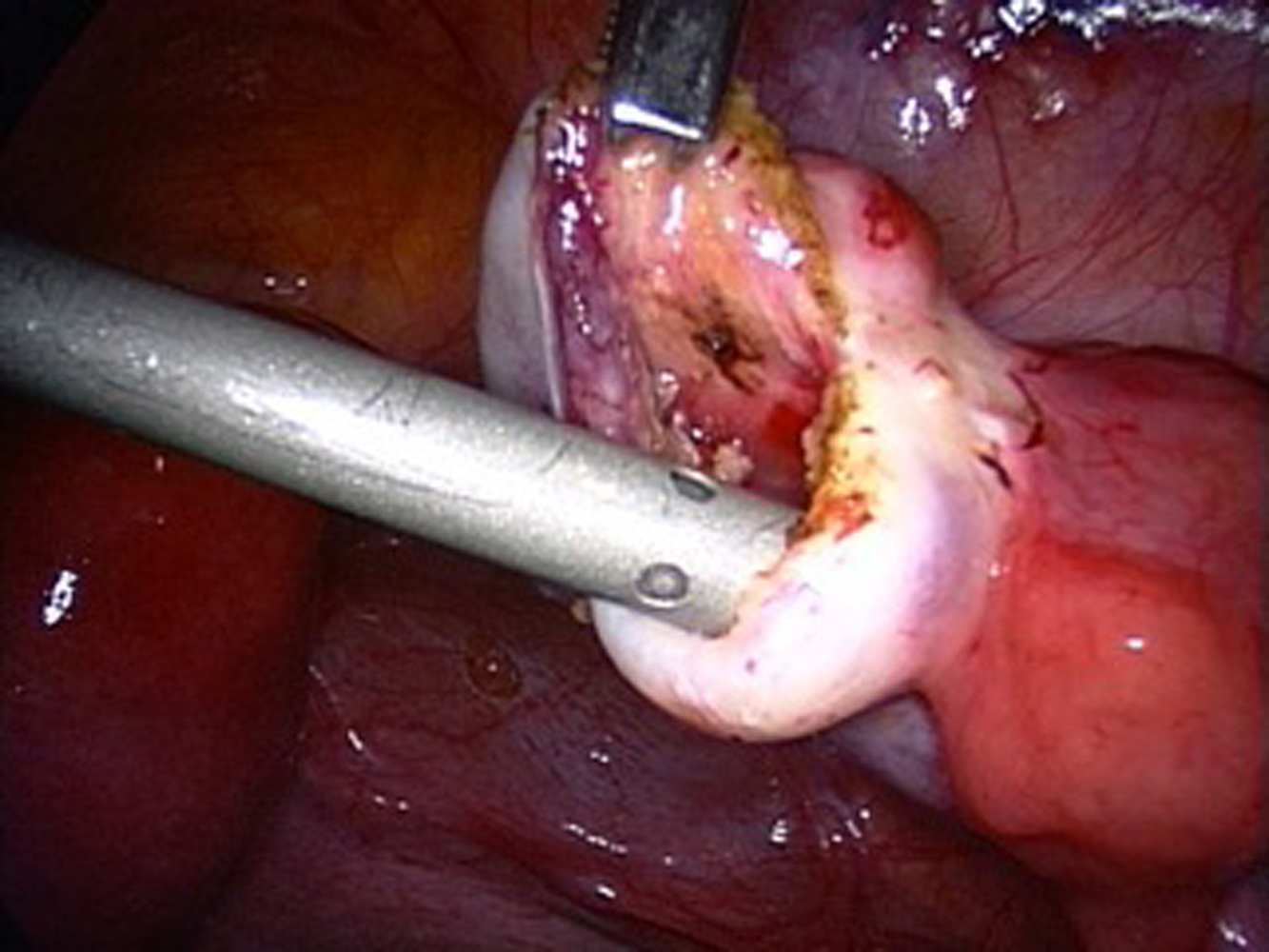 Endometriosis, endometrioma y reproducción asistida