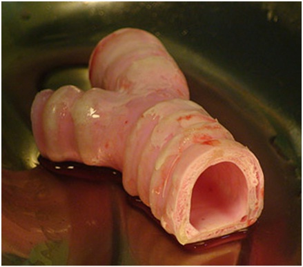 Primer trasplante con éxito de una tráquea artificial