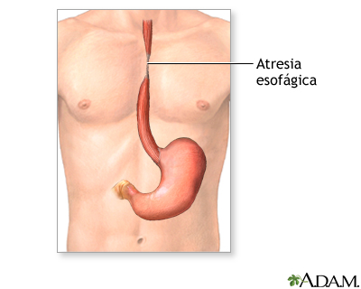 Una de las principales enfermedades (malformaciones) congénitas, la atresia esofágica