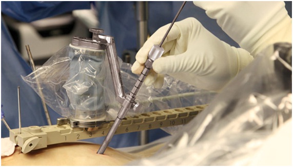 Cirugía Robótica de Columna Vertebral