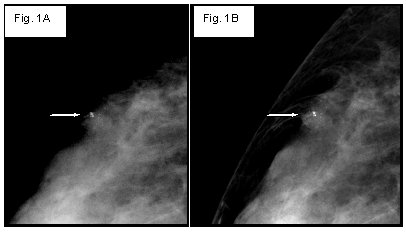 Biopsia de mama con guía por imagen