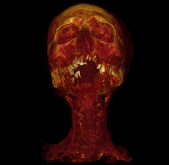 Mummies had atherosclerosis too