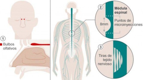 Paralítico vuelve a caminar gracias a un trasplante pionero