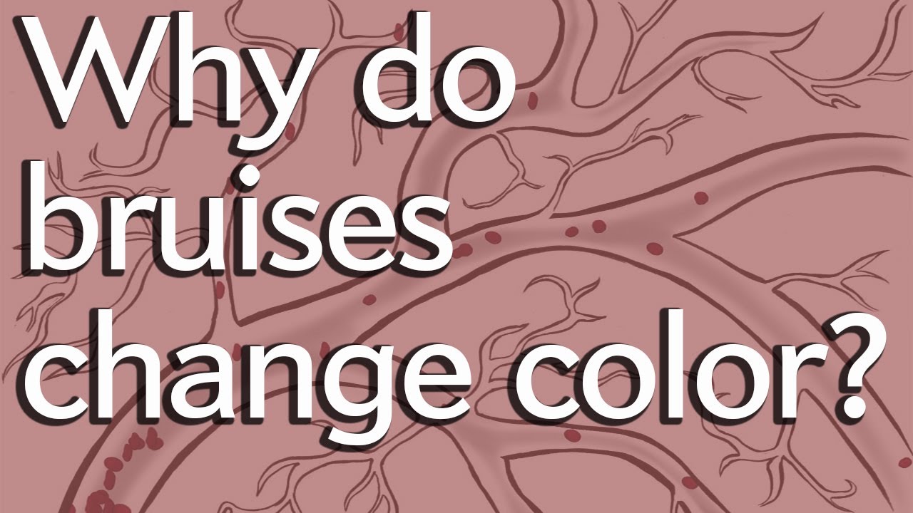 Instant Egghead – Why Do Bruises Change Color?