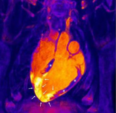 El corazón humano reacciona ante un infarto de manera diferente a como se pensaba