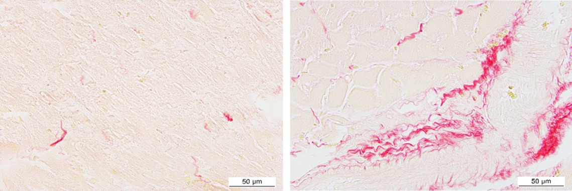 Nuevos datos sobre el desarrollo de fibrosis cardiaca en la obesidad