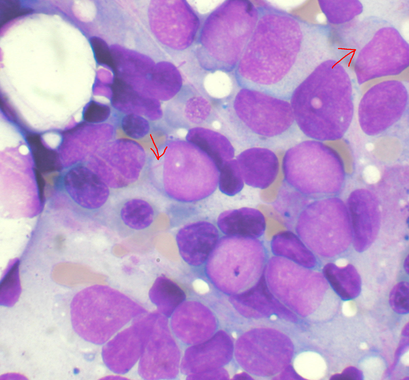 Cambios genéticos predicen el riesgo de padecer leucemia mieloide aguda