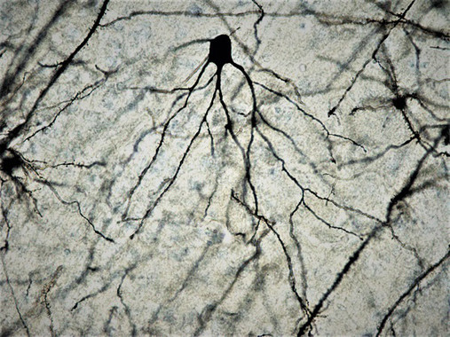 Una nueva terapia molecular permite tratar el ictus en su fase aguda