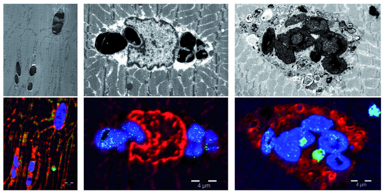 Descubren una nueva enfermedad muscular causada por una mutación genética