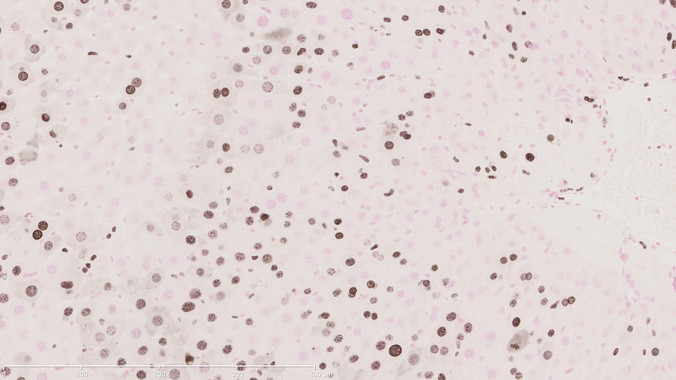 Proponen una nueva diana terapéutica contra el cáncer de hígado