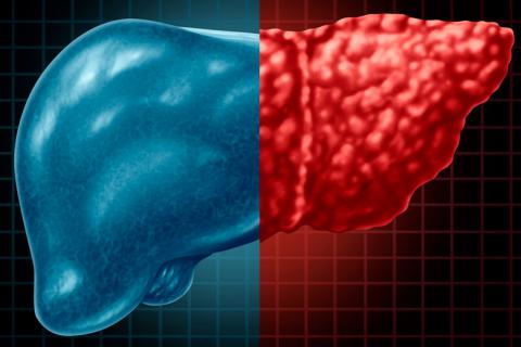 Un fármaco experimental mejora la diabetes tipo 2 y el hígado graso