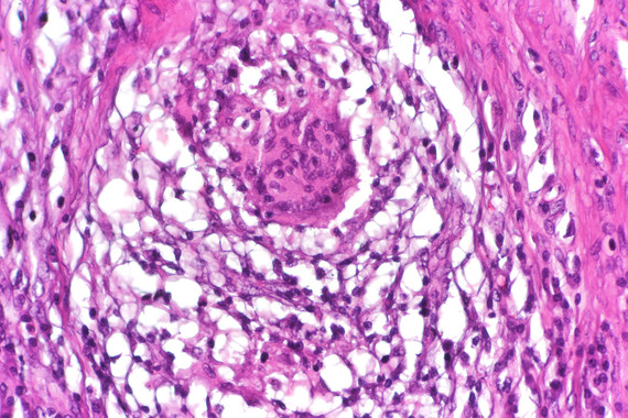 Un fármaco para tratar las fístulas de Crohn con células madre de donantes